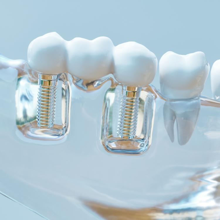 Dente naturale vs impianto
