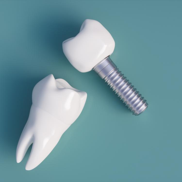 Dente naturale vs impianto